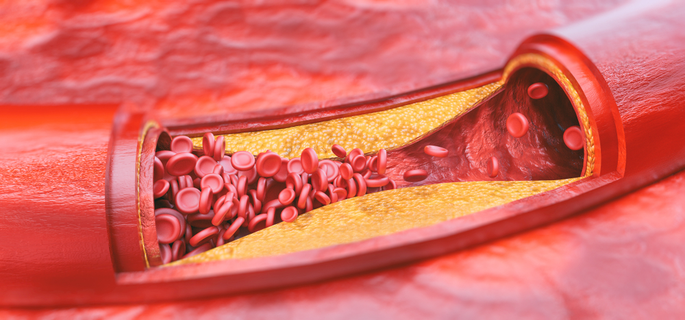 Blocked artery coronary heart disease